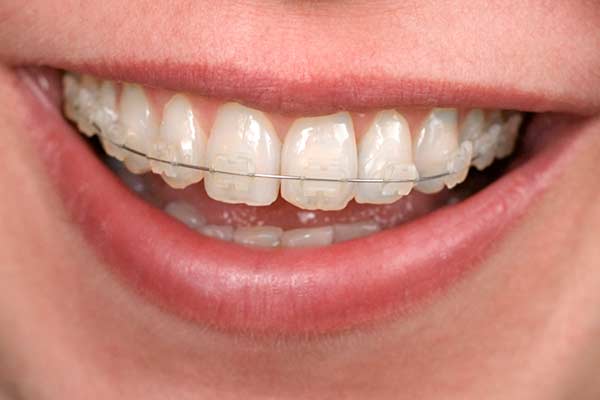 Clear Braces Image