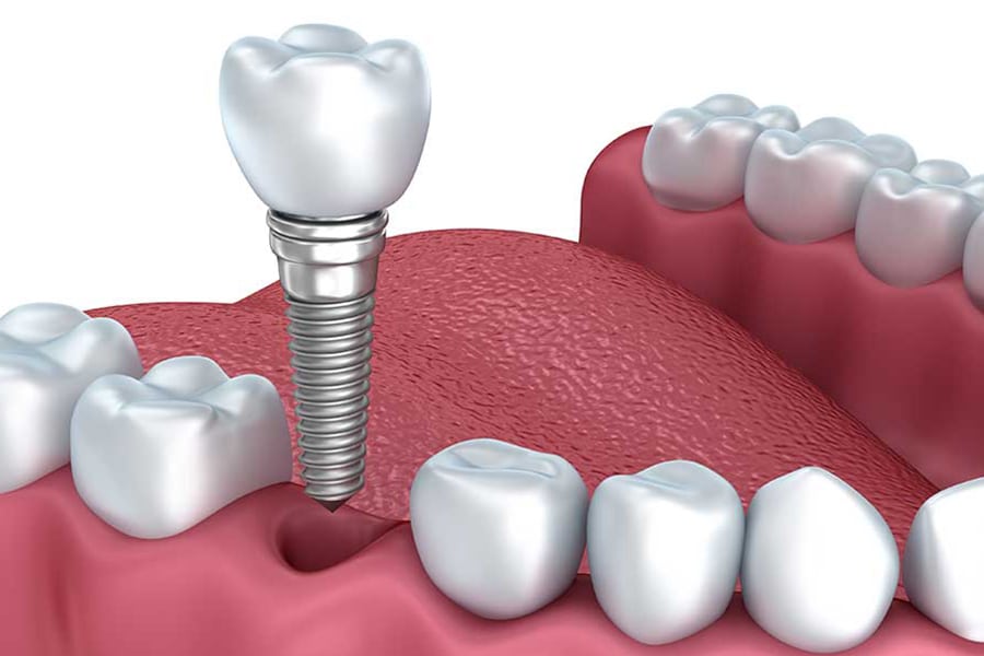 Single Tooth Dental Implants illustration