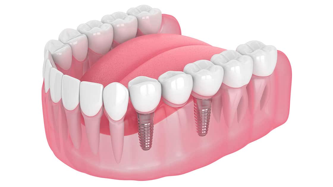 Implant Supported Bridges illustration