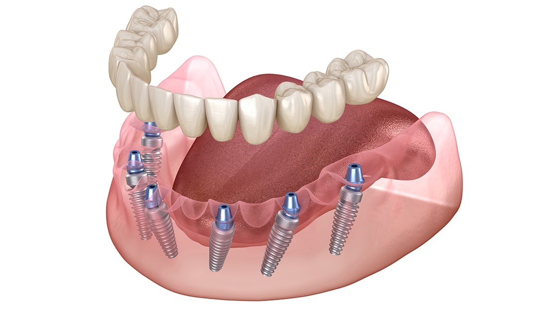 Implant Supported Dentures illustration